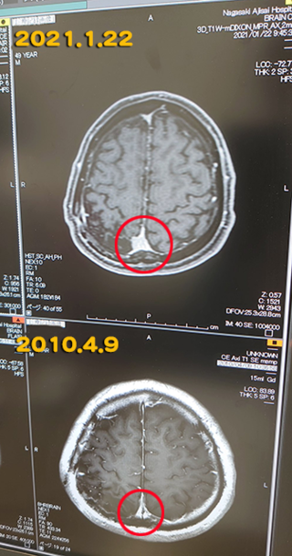 脳腫瘍20210122.png
